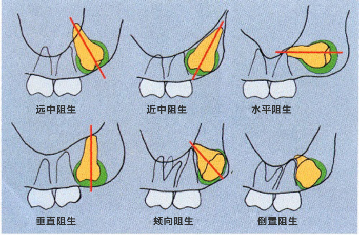 3,医院的选择 拔牙手术费用需要根据阻生智齿的阻生程度