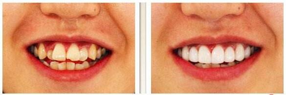 牙齿矫正的方法有哪些？
