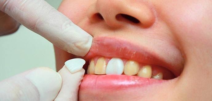 牙齿缺损可以怎样修复？