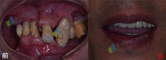 种植牙前后对比