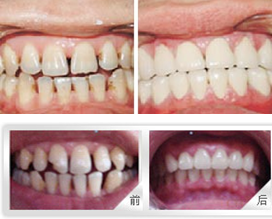 牙列稀疏矫正案例