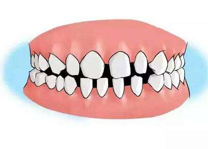 牙齿稀疏应该及时治疗