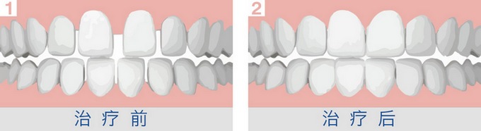 牙间隙矫正前后对比