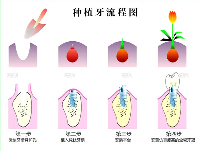 即刻种植牙