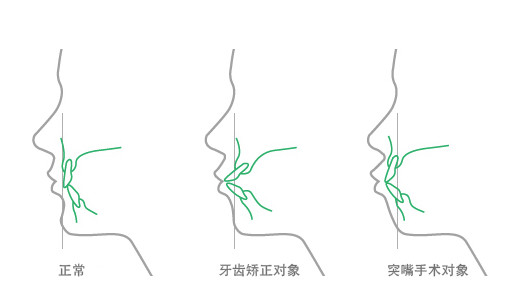 深圳成年人牙齿前突矫正哪种方法好？