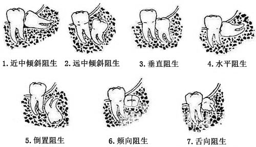 智齿的类型