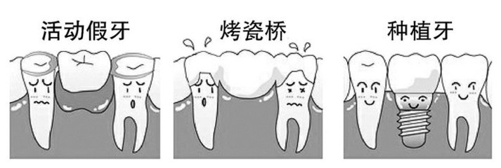 在深圳单颗牙缺失了可以怎么办