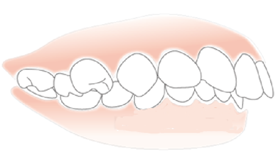 牙齿前突矫正深圳哪个医院比较好？