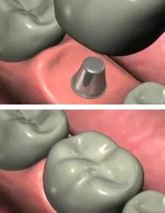 种植牙的过程是怎样的？