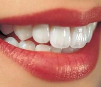 什么是氟斑牙?氟斑牙如何美白?