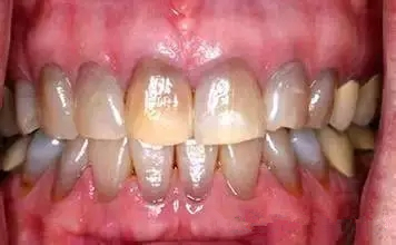 牙齿排列整齐的，轻度的四环素牙