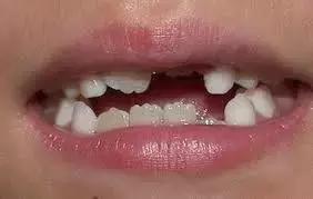 宝宝的牙齿长得难看？这可能是正常现象