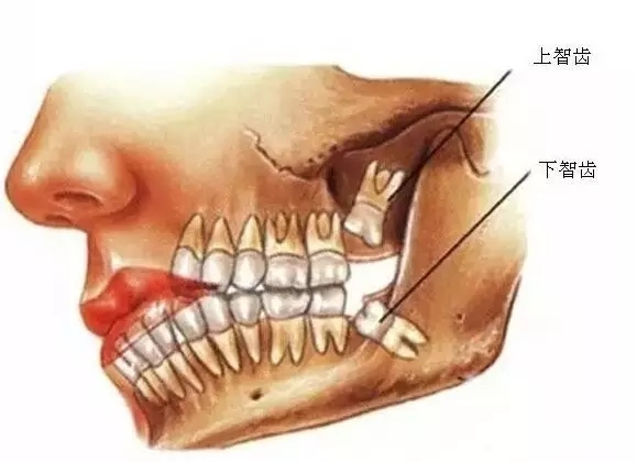 智齿拔出的较佳时间！