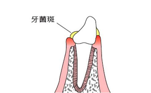 牙菌斑